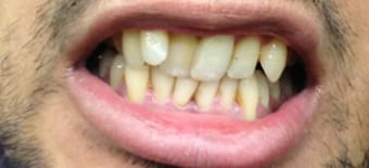 Before cosmetic Treatment Reading Smiles 