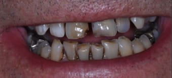 Before veneers Treatment Reading Smiles Before veneers Treatment Reading Smiles