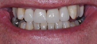 After Veneers Treatment Reading Smiles After Veneers Treatment Reading Smiles