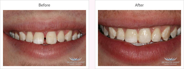 Six month smile before and after case 2 Kent