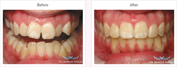 Six month smile before and after case 9
