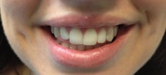 After Smile Makeover Treatment Reading Smiles 