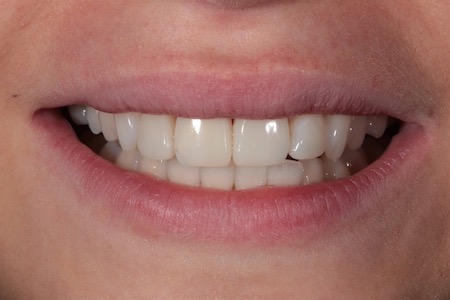 After Veneers Treatment Reading Smiles 