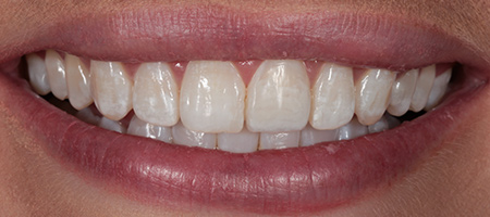 After Invisalign Treatment Reading Smiles 