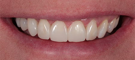 After Invisalign Treatment Reading Smiles 