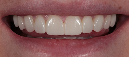 After Invisalign Treatment Reading Smiles 