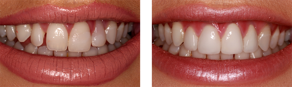 Dental Veneers Reading