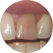 Discoloured teeth