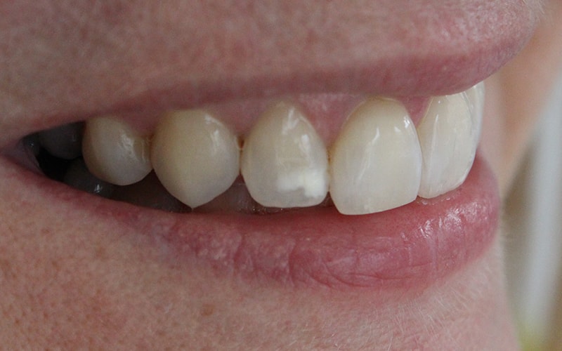 Icon White Spot Treatment - Reading Smiles Remove White Spot On Teeth