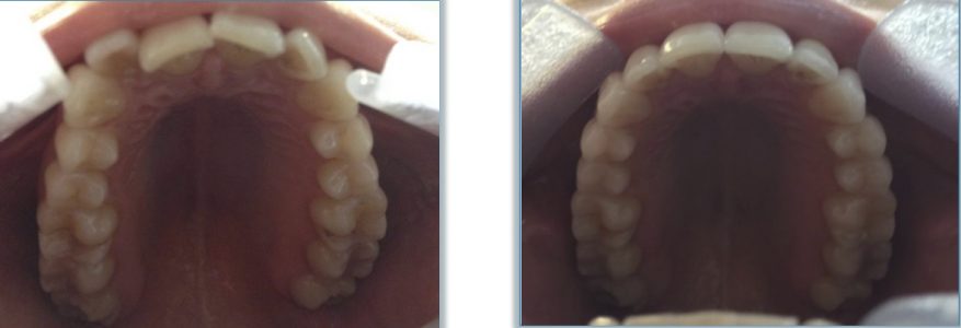 Invisalign Bride Wedding Day Smiles By Reading Smiles | Invisalign Braces