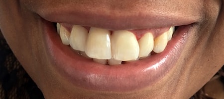 After cosmetic Treatment Reading Smiles After cosmetic Treatment Reading Smiles