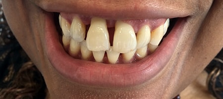 Before cosmetic Treatment Reading Smiles Before cosmetic Treatment Reading Smiles