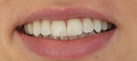 After Invisalign Treatment Smile Rooms Glasgow