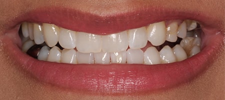 After Invisalign Treatment Smile Rooms Glasgow