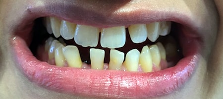 Before Invisalign Treatment Smile Rooms Glasgow
