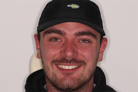 After Invisalign Treatment Smile Rooms Glasgow