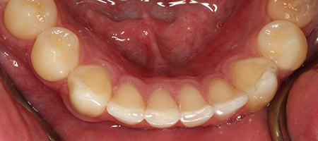 After Invisalign Treatment Smile Rooms Glasgow