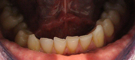 Before Invisalign Treatment Smile Rooms Glasgow