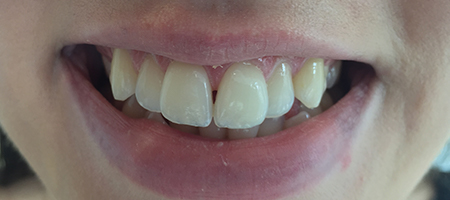 Before Invisalign Treatment Smile Rooms Glasgow