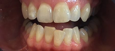 Before Invisalign Treatment Smile Rooms Glasgow