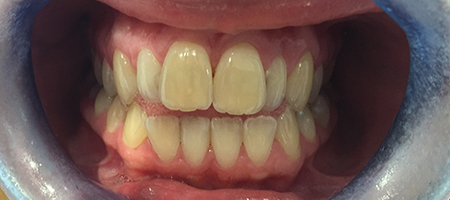 Before Invisalign Treatment Smile Rooms Glasgow