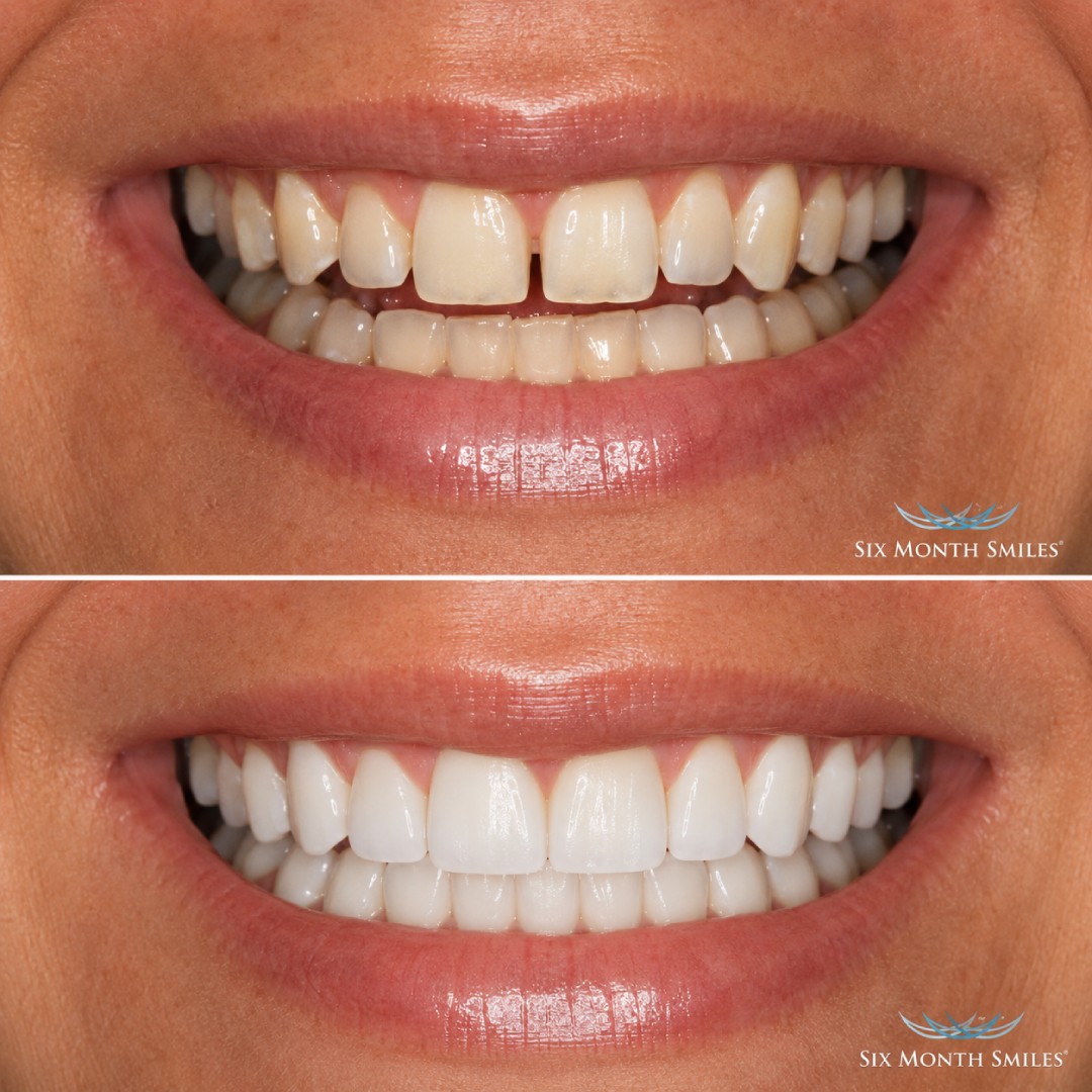 before-after-3
