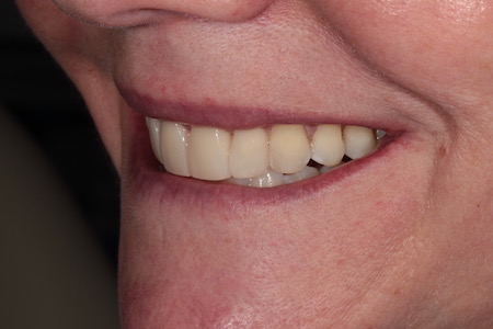 After Smile Makeover Treatment Reading Smiles 