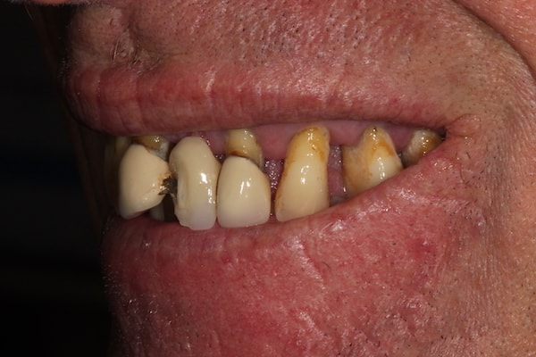 Before & After Dental Implants