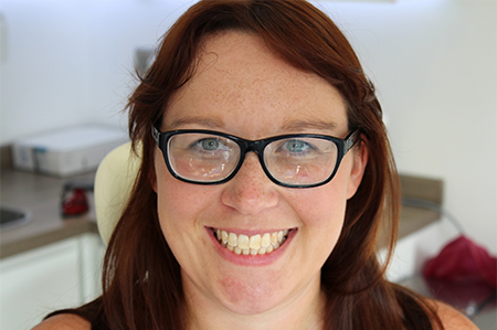 Before Invisalign Treatment Smile Rooms Glasgow