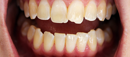 Before Invisalign Treatment Smile Rooms Glasgow