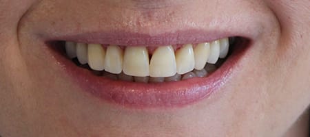 After Invisalign Treatment Reading Smiles 