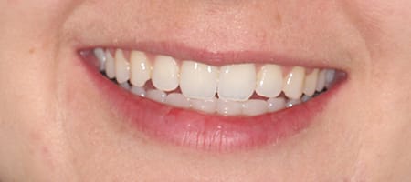 After Invisalign Treatment Smile Rooms Glasgow