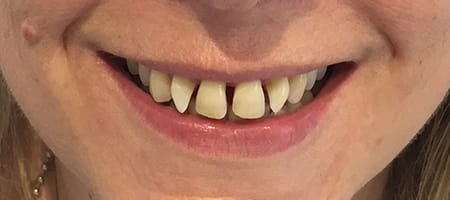 Before Invisalign Treatment Reading Smiles 