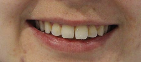 Before Invisalign Treatment Smile Rooms Glasgow