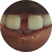 Gaps between teeth