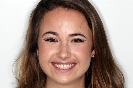 After Invisalign Treatment Smile Rooms Glasgow