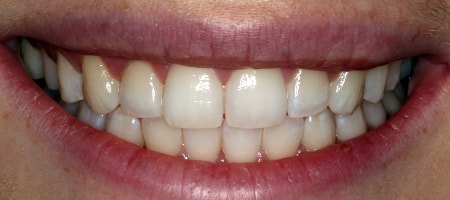 After Invisalign Treatment Smile Rooms Glasgow