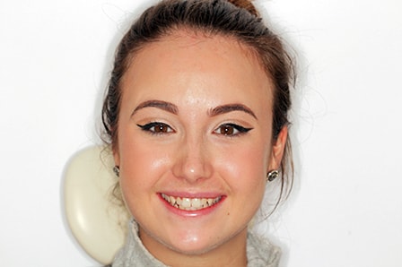 Before Invisalign Treatment Smile Rooms Glasgow