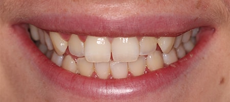 Before Invisalign Treatment Smile Rooms Glasgow