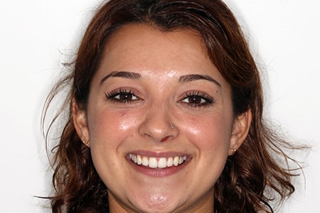 After Invisalign Treatment Smile Rooms Glasgow