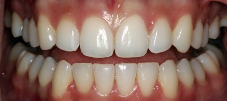 After Invisalign Treatment Smile Rooms Glasgow