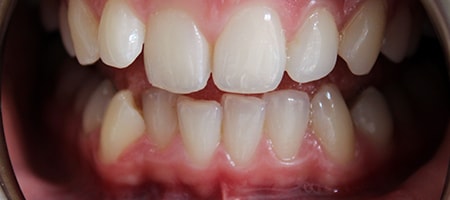 Before Invisalign Treatment Smile Rooms Glasgow
