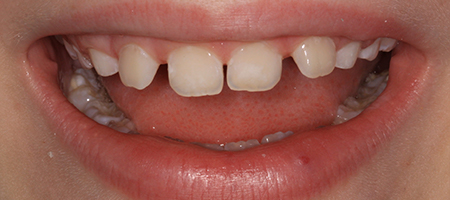 White Spots On Teeth Before