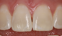 tooth sculting after. Teeth are aligned straight with smooth edges