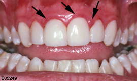 Swollen, red gums around the tooth
