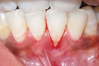 Gum has recessed, showing the root of the tooth with bleeding around the gums.