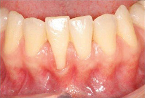 Gum has recessed, showing the root of the tooth