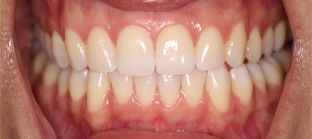 After Invisalign Treatment Smile Rooms Glasgow