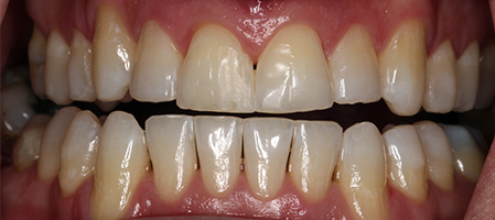 After Invisalign Treatment Smile Rooms Glasgow