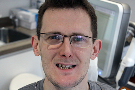 Before Invisalign Treatment Smile Rooms Glasgow